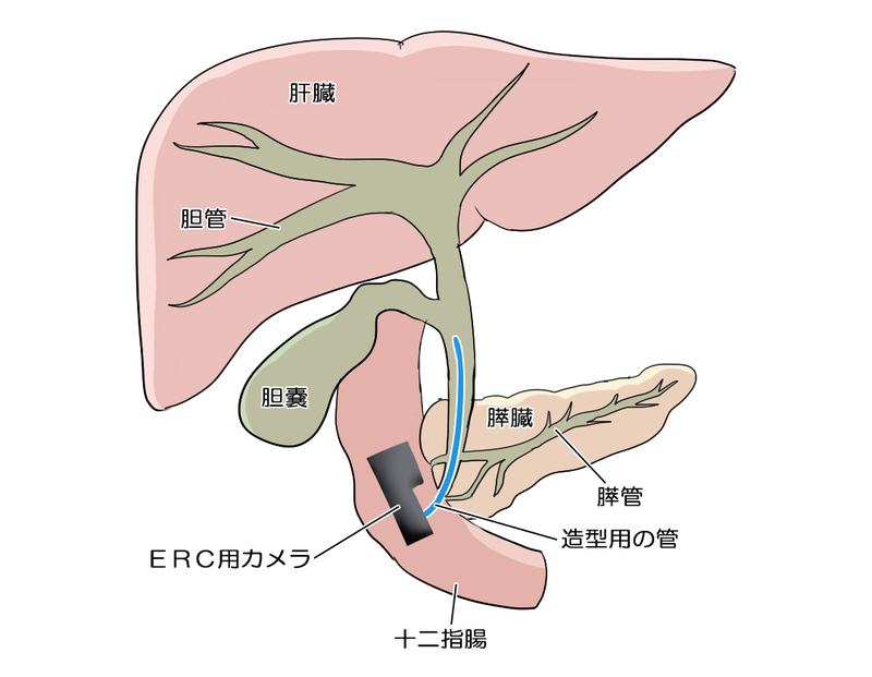 内視鏡的逆行性胆管膵管造影