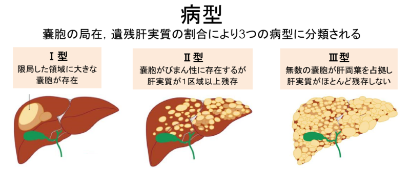 多発性肝嚢胞 病型