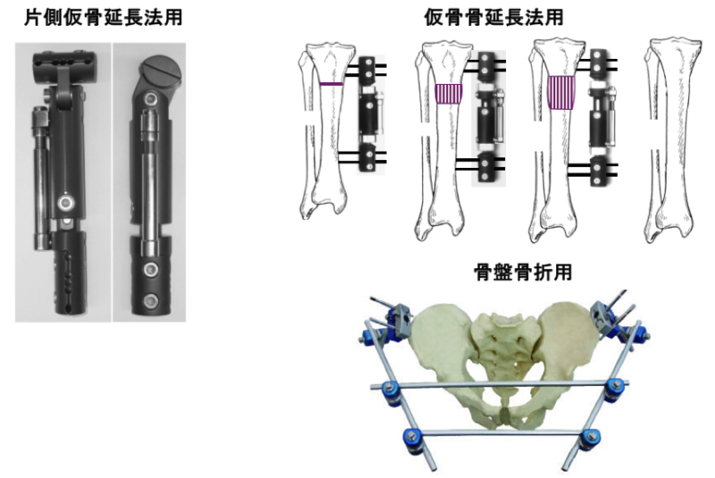 片側式創外固定器