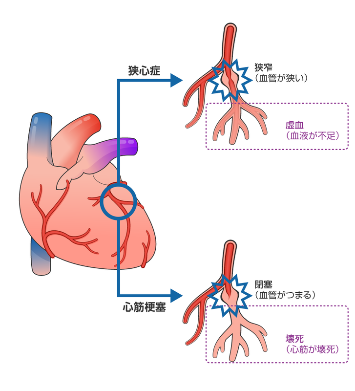狭心症と心筋梗塞の違い