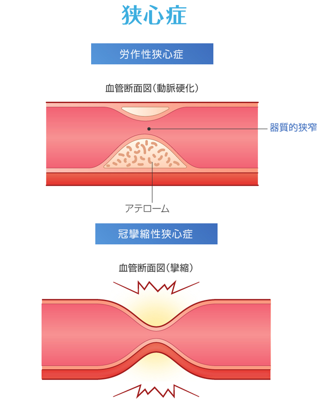 労作性狭心症