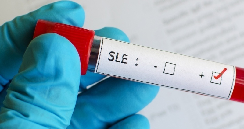 全身性エリテマトーデス(SLE)の診断。診断基準には何が含まれる?