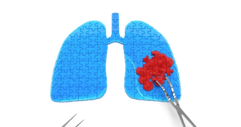 肺がんの手術。体に負担が少ない手術法「胸腔鏡手術」とは