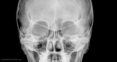 眼窩内腫瘍の治療後はどのような経過をたどるのか
