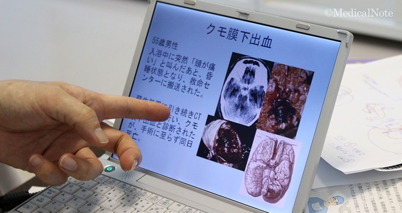 くも膜下出血の原因-くも膜下出血のリスクファクターとは
