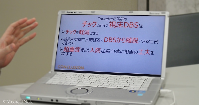 重度難治性チックに有効な脳深部刺激療法(DBS)とは