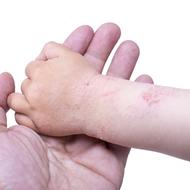 子どもがかかる病気と治療③ ブドウ球菌性熱傷様皮膚症候群/湿疹/じんましん