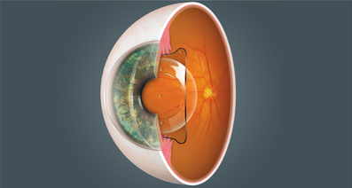 レーシックの次に登場した眼内コンタクトレンズ - 手術の費用や術後の安全性