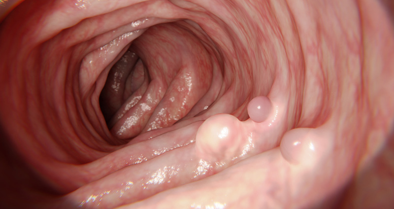 大腸がんの手術について 開腹手術・腹腔鏡下手術の特徴とは