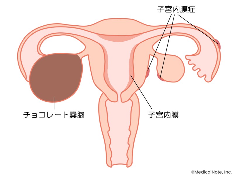 子宮内膜症とはどんな病気?
