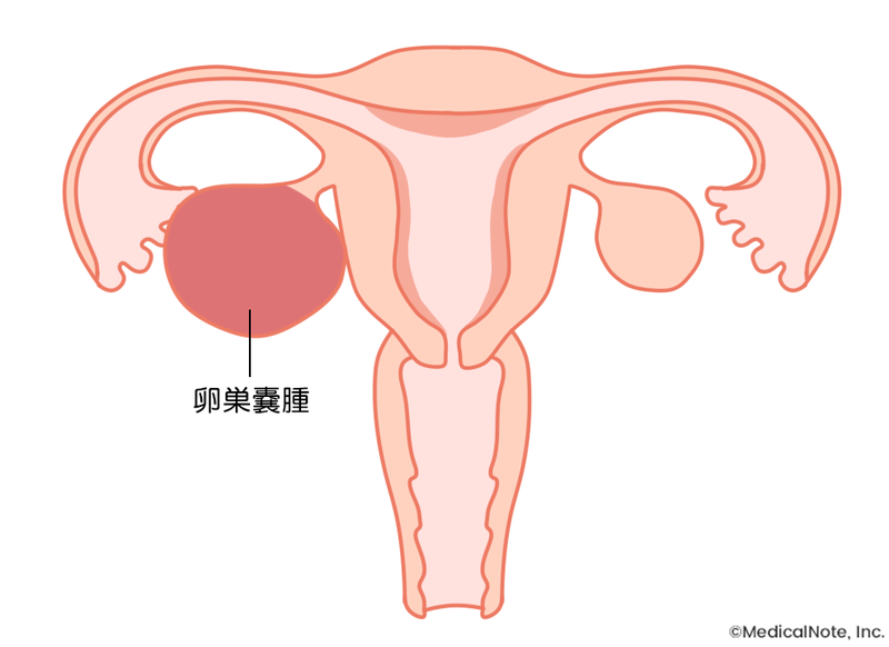 卵巣嚢腫とはどんな病気?