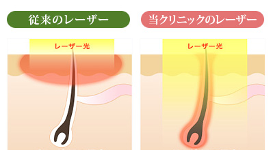 VIOゾーンでも痛みを感じにくい脱毛機