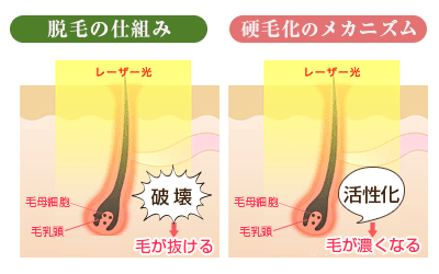 脱毛の仕組みと硬毛化のメカニズム