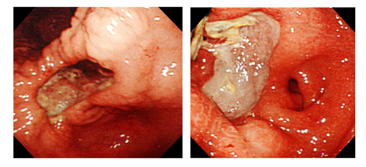 Hp(+)・NSAIDs(+)の患者の胃角部潰瘍。左:治療前、A1 Stage。右:治療中、A2 Stage