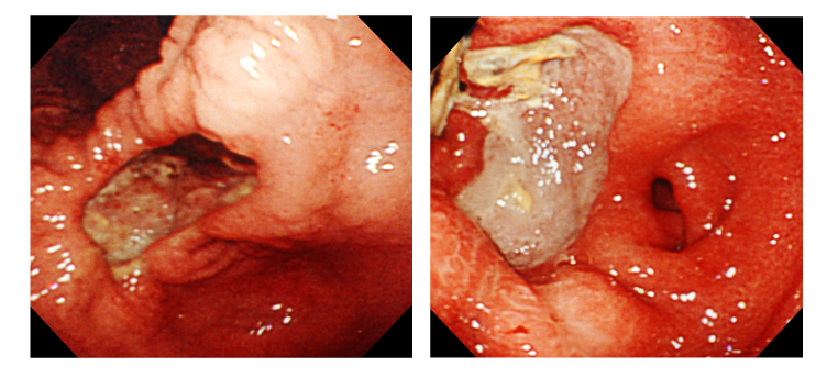 Hp（＋）・NSAIDs（＋）の患者の胃角部潰瘍。左：治療前、A1 Stage。右：治療中、A2 Stage