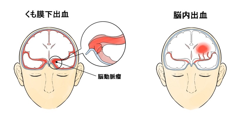 脳内出血とくも膜下出血