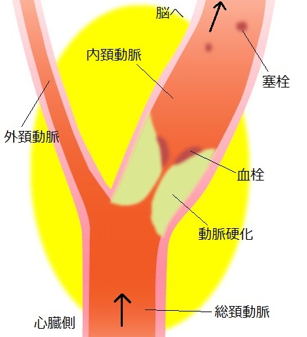 頚動脈と動脈硬化の様子