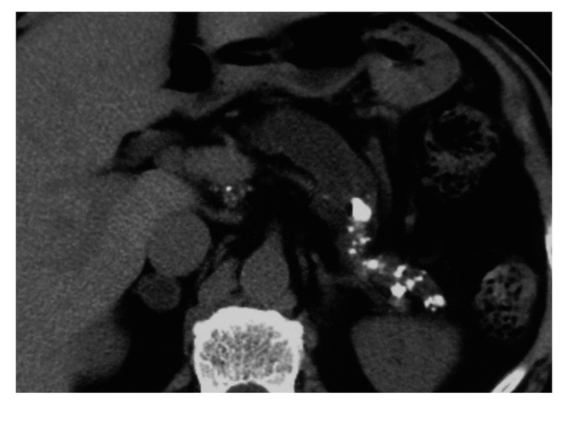 慢性膵炎の膵石のCT像