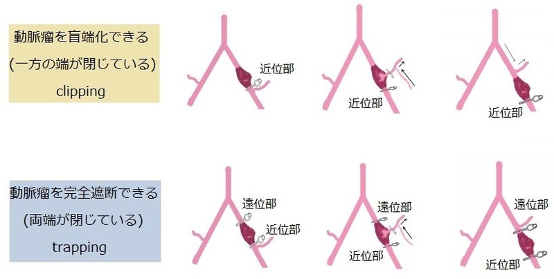 動脈瘤ができた位置によってクリップで閉塞する位置が変わる