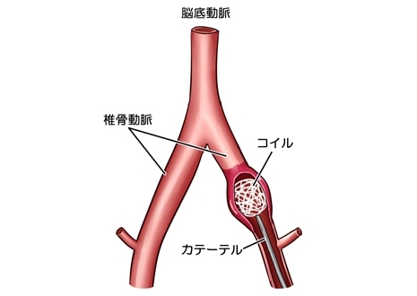 椎骨動脈解離性脳動脈瘤の血管内治療 動脈瘤のある側の椎骨動脈が塞栓されても対側の椎骨動脈によって血流が確保できる
