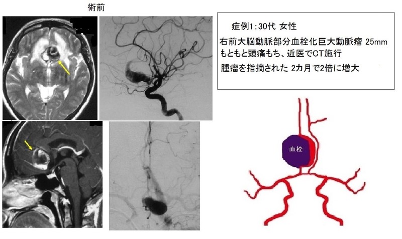 部分血栓化巨大動脈瘤の症例1:30代女性 右前大脳動脈部分血栓化巨大動脈瘤 25mm
