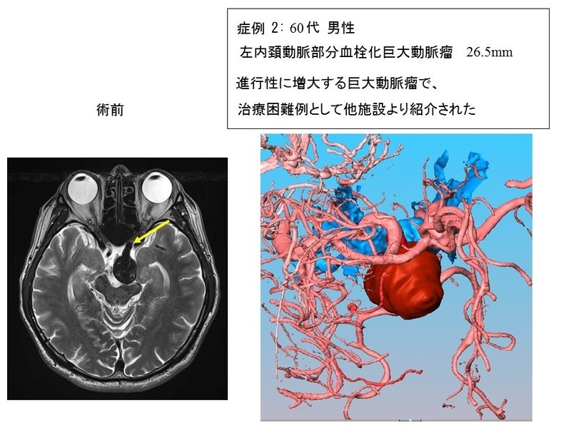 血栓化動脈瘤の症例2:60代男性左内頚動脈部分血栓化巨大動脈 26.5mm