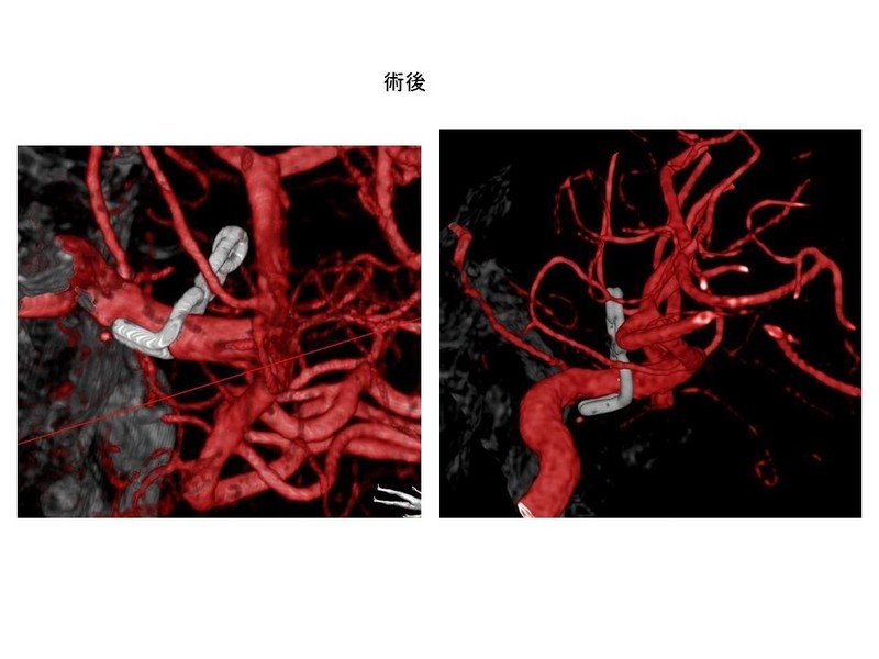 血栓化動脈瘤の症例2:60代男性 左内頚動脈部分血栓化巨大動脈 26.5mm 術後