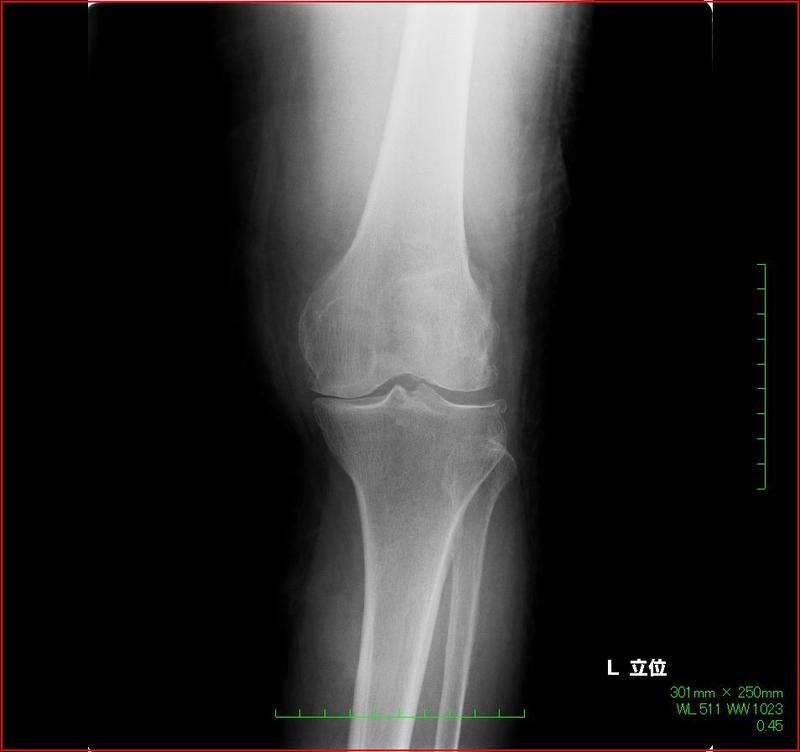関節リウマチで変形した膝関節