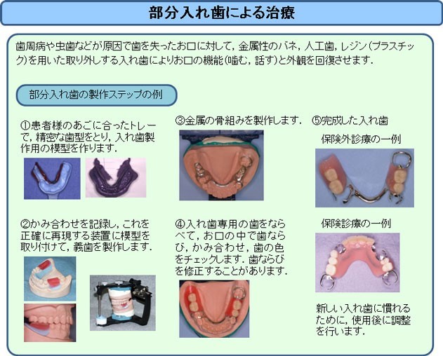 部分入れ歯による治療（東京医科歯科大学 義歯外来のページより引用）