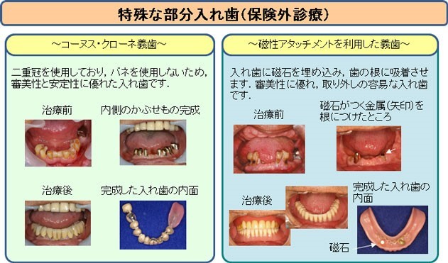 特殊な部分入れ歯（東京医科歯科大学 義歯外来のページより引用）