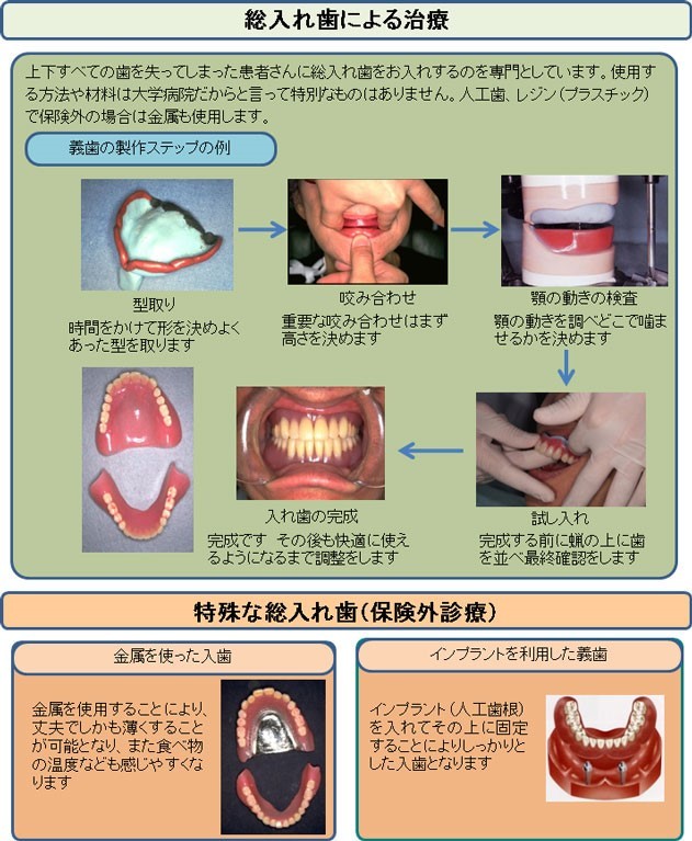 総入れ歯による治療(東京医科歯科大学 義歯外来のページより引用)