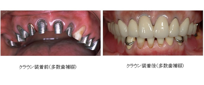 クラウン装着前・後(写真提供:水口俊介先生)
