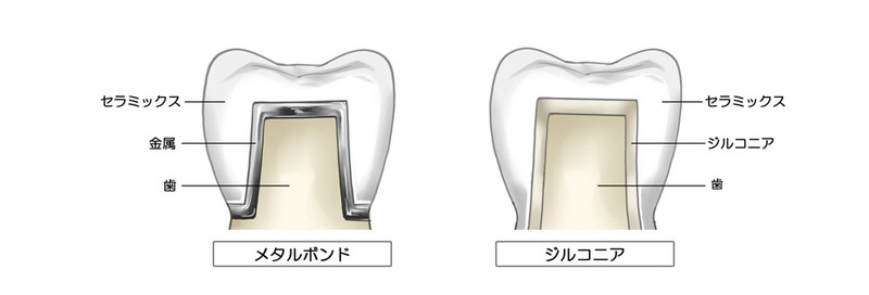 メタルボンドクラウンとジルコニアクラウン