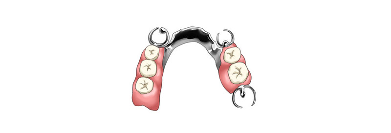 金属床義歯のイメージ