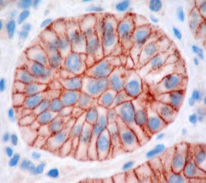 神経内分泌腫瘍細胞のソマトスタチンレセプターを免疫学的に染色した写真