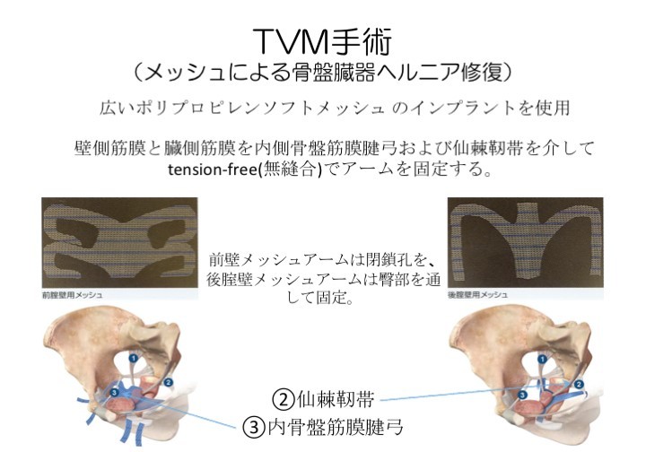 TVM（石川哲也先生提供）