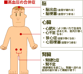 高血圧の合併症