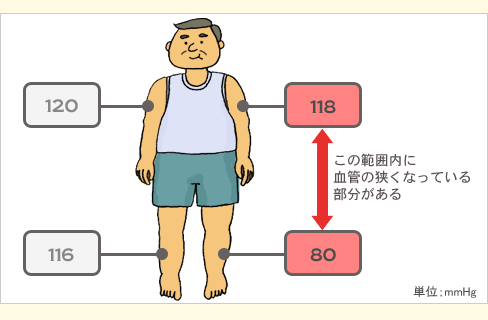 足の動脈が狭くなっていると、その部分の血圧が下がる
