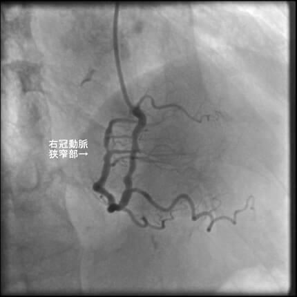 図1-1 右冠動脈造影