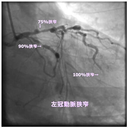 図1-2 左冠動脈造影像