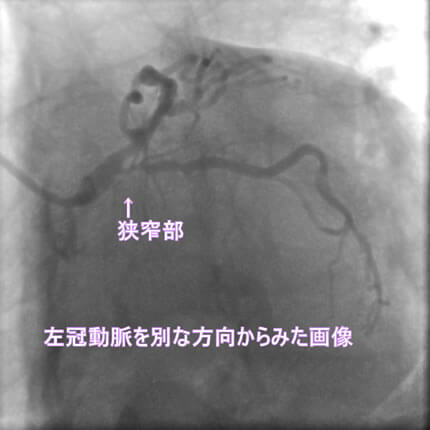 図1-3 左冠動脈造影像