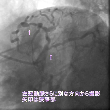 図1-4 左冠動脈造影像