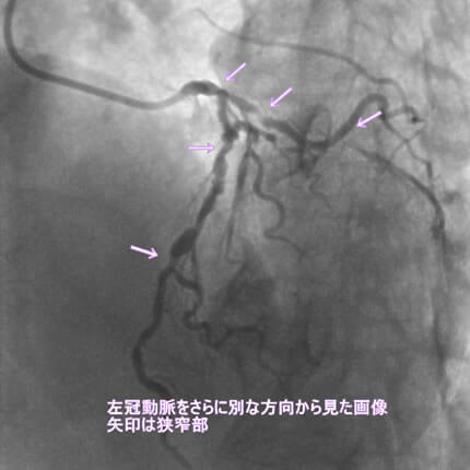 図1-5 左冠動脈造影像
