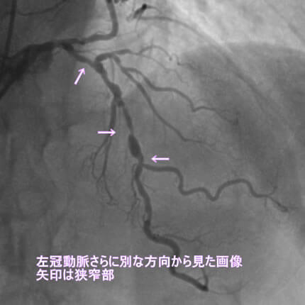 図1-6 左冠動脈造影像