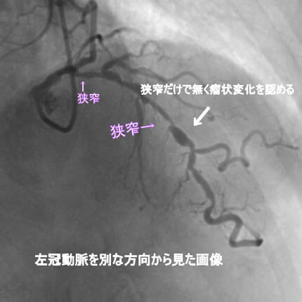 図1-7 左冠動脈造影像