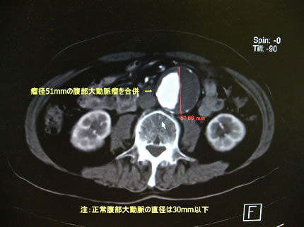 図1-8 腹部大動脈CT