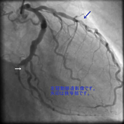 図2-2 左冠動脈造影像