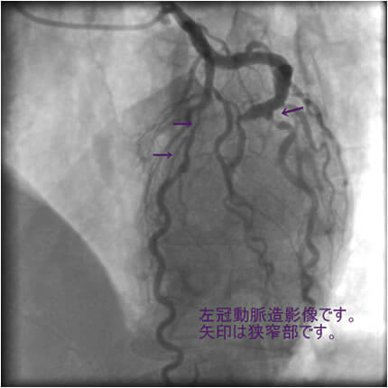図2-3 左冠動脈造影像