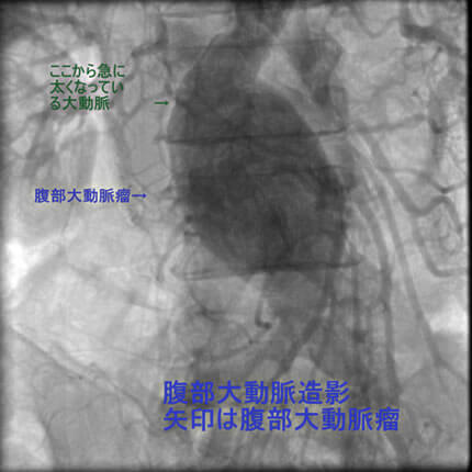 図2-4 腹部大動脈造影
