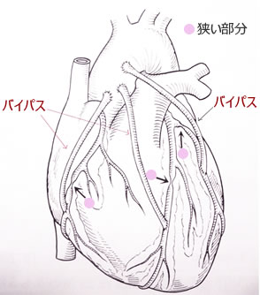 図1:冠動脈バイパス術の模式図 (心疾患の診断と手術:南江堂 新井達太著より引用)